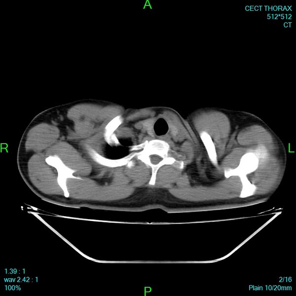 File:Bone metastases from lung carcinoma (Radiopaedia 54703-60937 Axial non-contrast 2).jpg