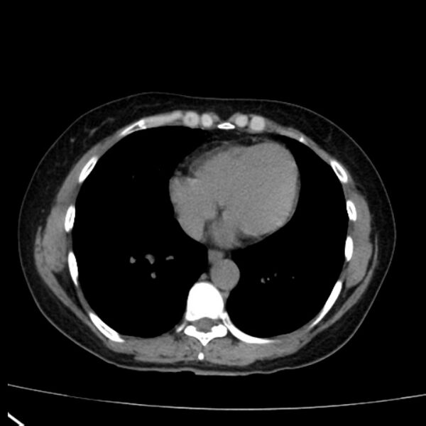 File:Bosniak renal cyst - type I (Radiopaedia 27479-27675 Axial non-contrast 1).jpg