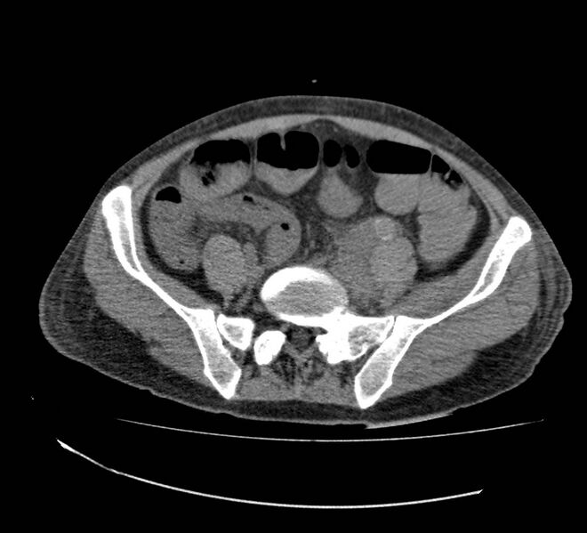 File:Bowel lymphoma complicated by bleeding after therapy (Radiopaedia 55601-62110 Axial non-contrast 60).jpg