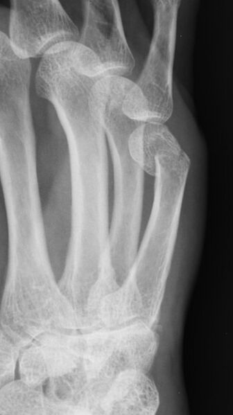 File:Boxer's fracture (Radiopaedia 10739-11200 Oblique 1).jpg