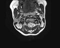 Brachial plexus birth palsy (Radiopaedia 68118-77604 Axial T2 2).jpg