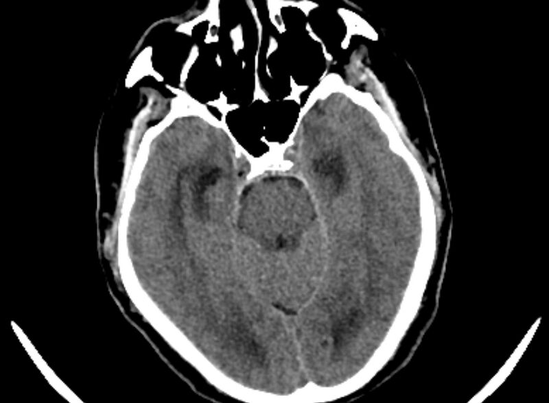 File:Brain abscess complicated by intraventricular rupture and ventriculitis (Radiopaedia 82434-96575 Axial non-contrast 3).jpg