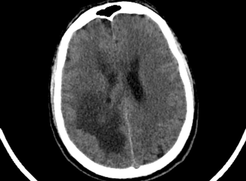 Brain abscess complicated by intraventricular rupture and ventriculitis (Radiopaedia 82434-96575 Axial non-contrast 73).jpg