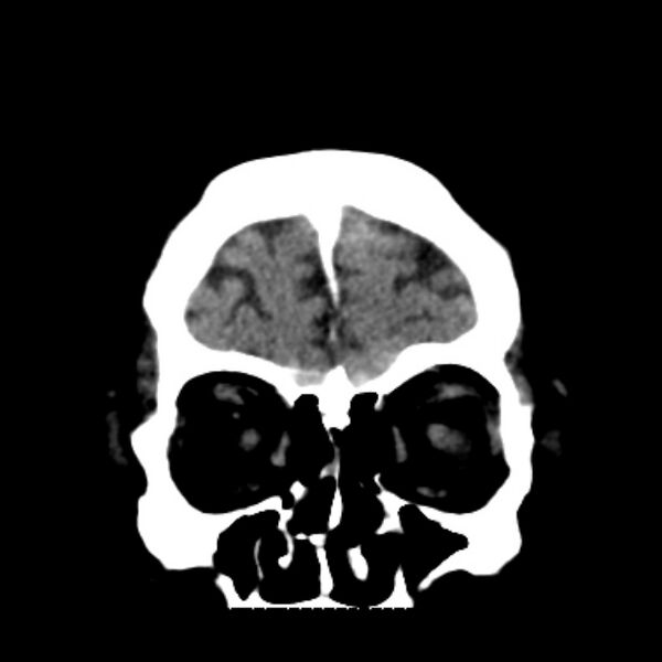 File:Brain cortical laminar necrosis (Radiopaedia 25822-25971 C 9).jpg
