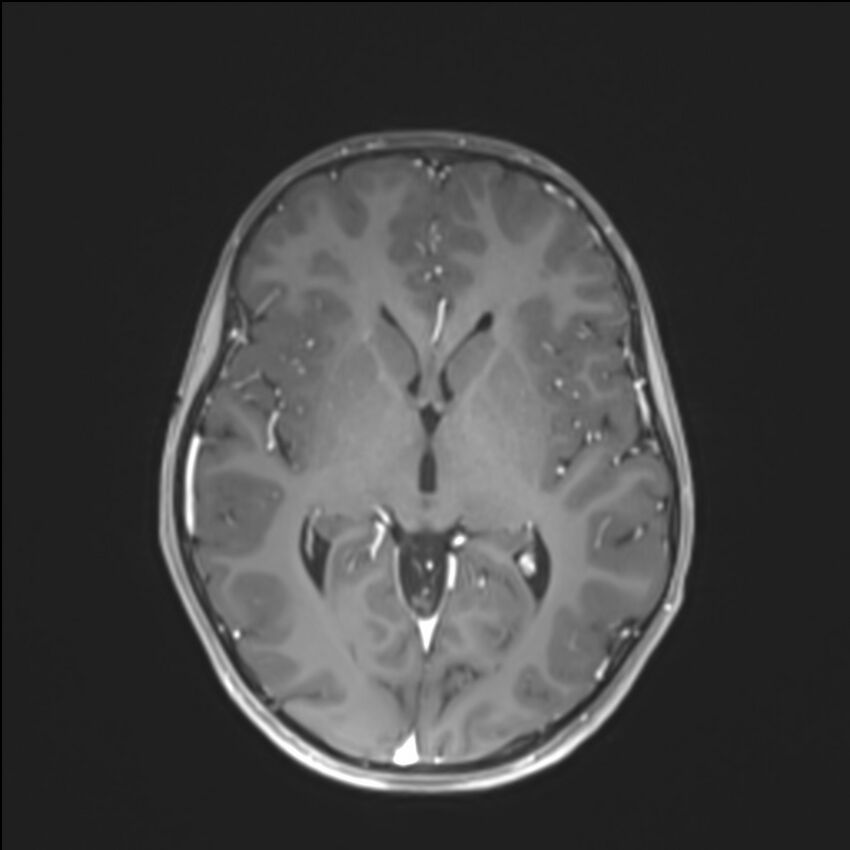 Brainstem glioma (Radiopaedia 70548-80674 Axial T1 C+ 81).jpg
