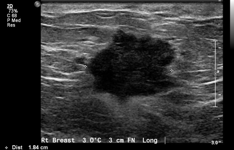 File:Breast cancer and multiple circumscribed masses (Radiopaedia 62456-70700 A 4).jpeg