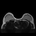 Breast implants - MRI (Radiopaedia 26864-27035 Axial T2 18).jpg