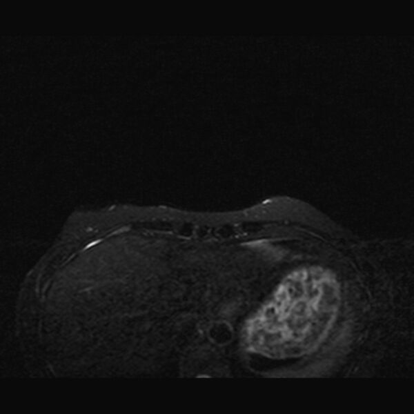 File:Breast implants - MRI (Radiopaedia 26864-27035 T2 SPAIR 3).jpg