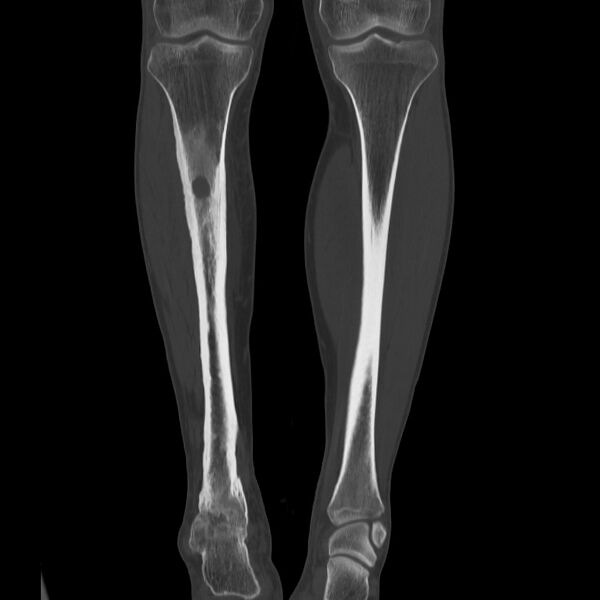 File:Brodie abscess - tibia (Radiopaedia 66028-75204 Coronal bone window 30).jpg