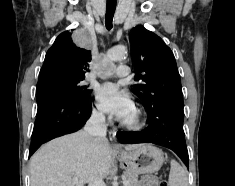 File:Bronchogenic carcinoma with superior vena cava syndrome (Radiopaedia 36497-38054 Coronal C+ delayed 33).jpg
