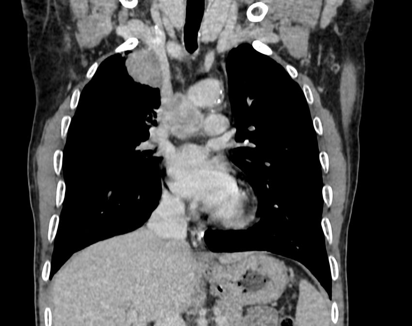 Bronchogenic carcinoma with superior vena cava syndrome (Radiopaedia 36497-38054 Coronal C+ delayed 33).jpg
