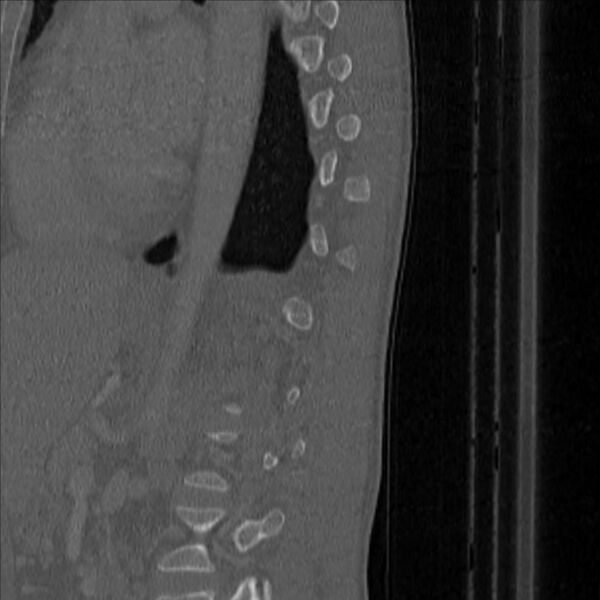 File:Bulging of paraspinal line in traumatic thoracal spinal compression fracture (Radiopaedia 29221-35872 Sagittal bone window 49).jpg