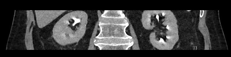 File:Buried bumper syndrome - gastrostomy tube (Radiopaedia 63843-72575 Coronal Inject 65).jpg