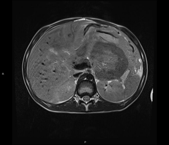 File:Burkitt lymphoma (bowel) (Radiopaedia 68839-78557 Axial T2 19).jpg