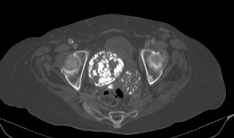File:Calcified fibroids (Radiopaedia 20306-20228 Axial bone window 19).jpg