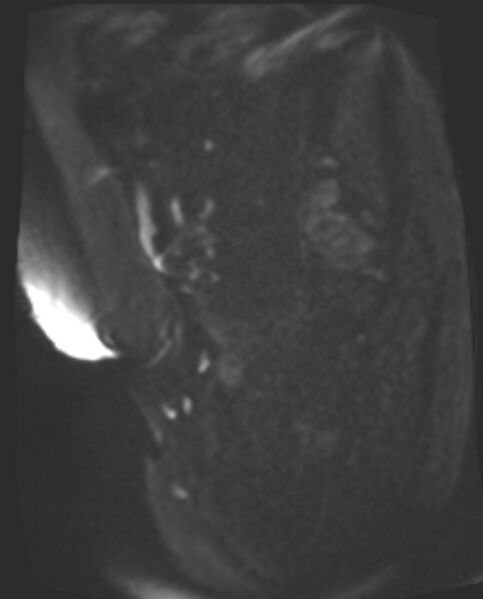 File:Cancer cervix - stage IIb (Radiopaedia 75411-86615 Sagittal DWI 69).jpg