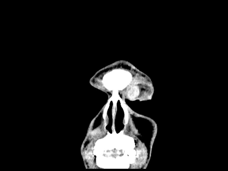 File:Capillary hemangioma of the orbit (Radiopaedia 44610-48358 B 12).jpg