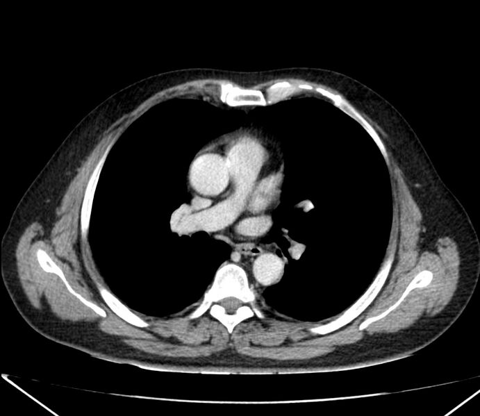 File:Carcinoid tumor with hepatic metastases (Radiopaedia 22651-22670 C 16).jpg