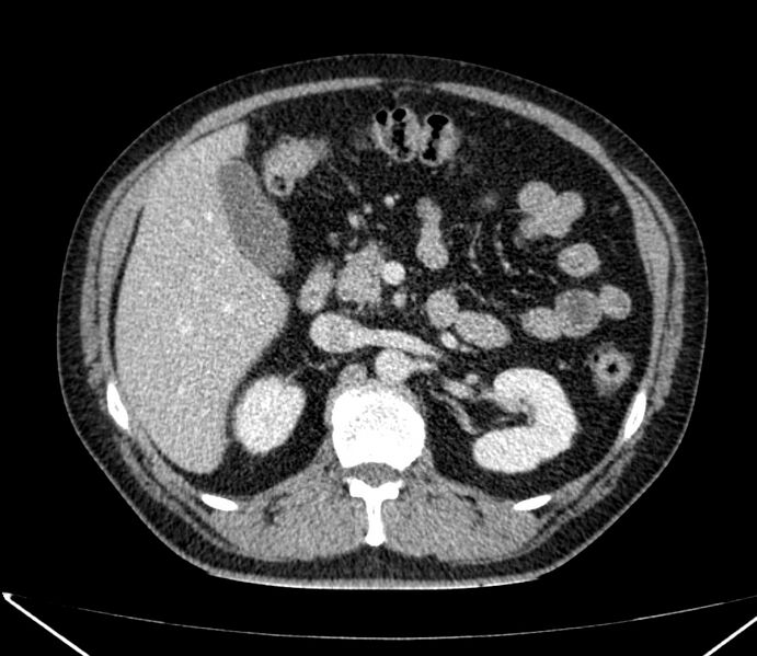 File:Carcinoid tumor with hepatic metastases (Radiopaedia 22651-22670 C 43).jpg