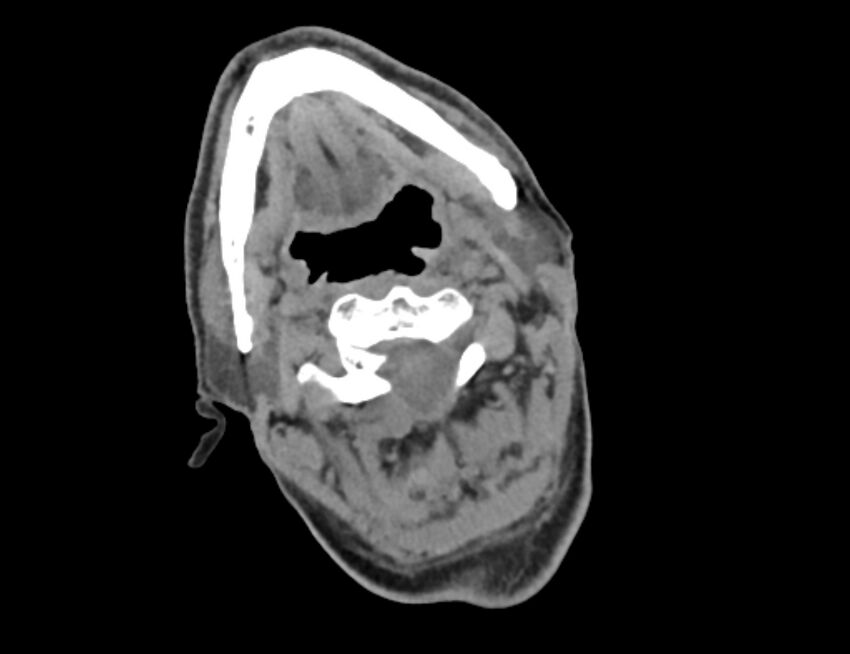 Carotid artery pseudoaneurysm (Radiopaedia 84030-99259 Axial non-contrast 8).jpg