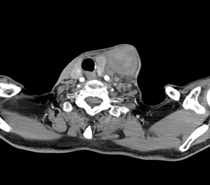 File:Carotid artery pseudoaneurysm (Radiopaedia 84030-99259 C 62).jpg