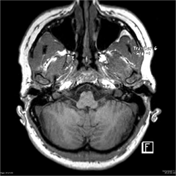 File:Cavernous malformation (cavernous angioma or cavernoma) (Radiopaedia 36675-38237 Axial T1 18).jpg