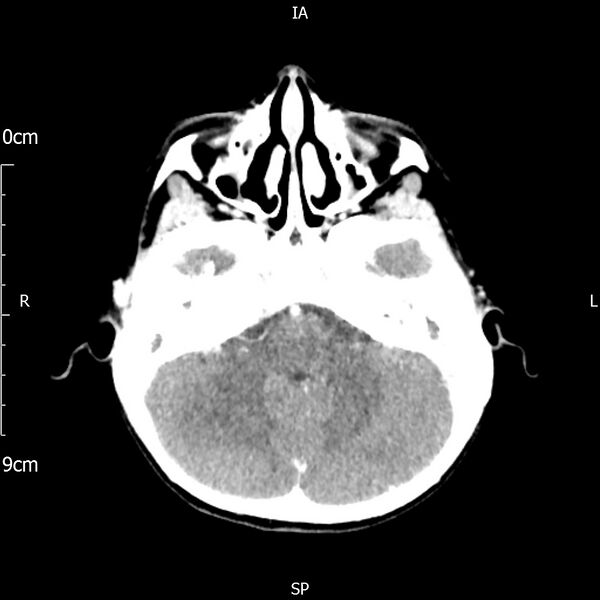 File:Cavernous sinus thrombosis (Radiopaedia 79414-92510 Axial Brain 66).jpg