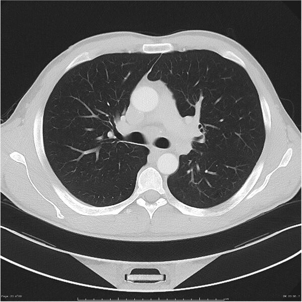 File:Cavitating lung cancer (Radiopaedia 25796-25945 Axial lung window 21).jpg