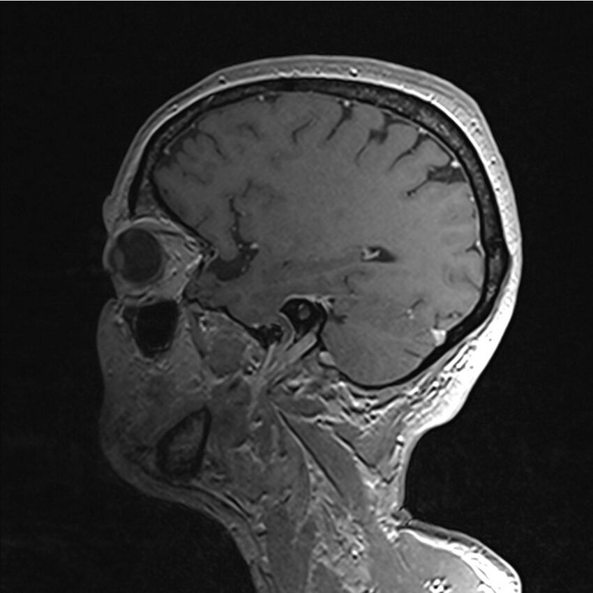 Central base of skull meningioma (Radiopaedia 53531-59549 Sagittal T1 C+ 59).jpg