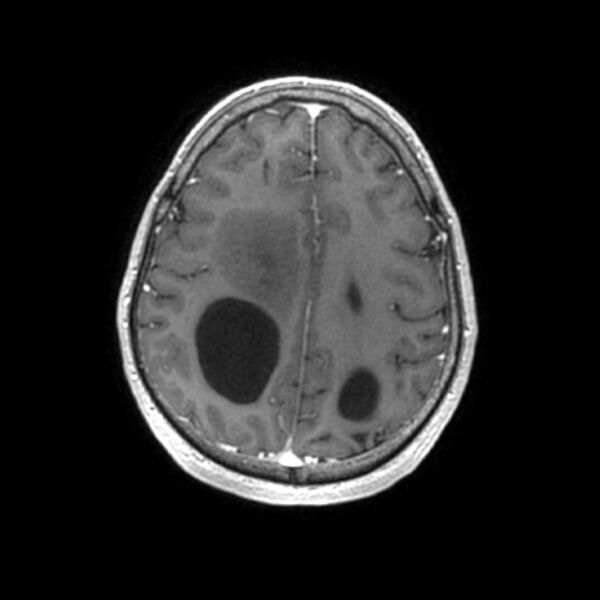 File:Central neurocytoma (Radiopaedia 67618-77021 Axial T1 C+ 22).jpg