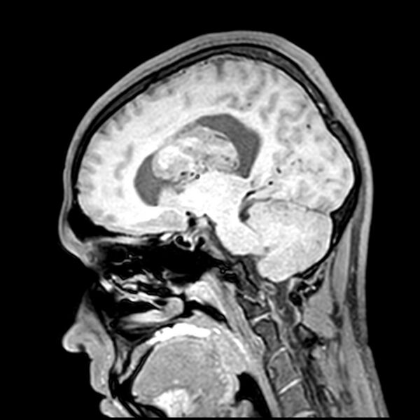 File:Central neurocytoma (Radiopaedia 79320-92380 Sagittal T1 151).jpg