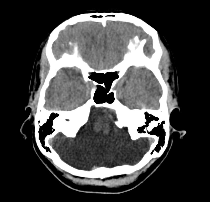 Cerebellar agenesis (Radiopaedia 30203-30817 Axial non-contrast 10).jpg