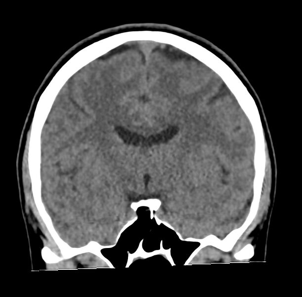 File:Cerebellar agenesis (Radiopaedia 30203-30817 Coronal non-contrast 16).jpg