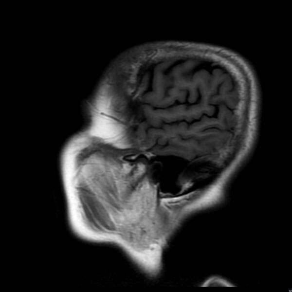 File:Cerebellar ataxia with neuropathy and vestibular areflexia syndrome (CANVAS) (Radiopaedia 74283-85159 Sagittal FLAIR 3).jpg