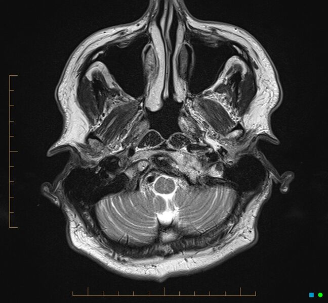 File:Cerebellar gangliocytoma (Radiopaedia 65377-74422 Axial T2 3).jpg