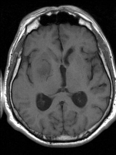 File:Cerebellopontine angle meningioma (Radiopaedia 24459-24764 Axial T1 12).jpg