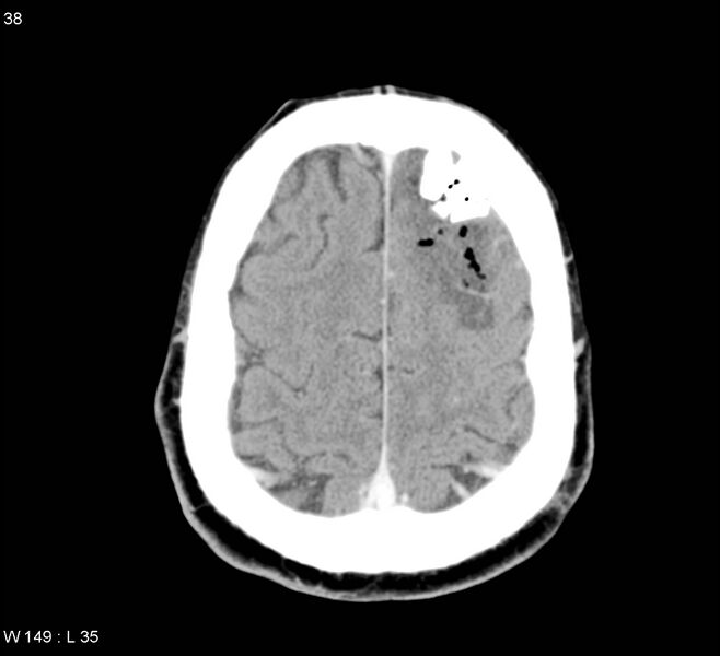 File:Cerebral abscess (Radiopaedia 5150-6933 Axial C+ delayed 7).jpg