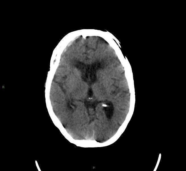 File:Cerebral amyloid angiopathy-associated lobar intracerebral hemorrhage (Radiopaedia 58377-65514 Axial non-contrast 26).jpg