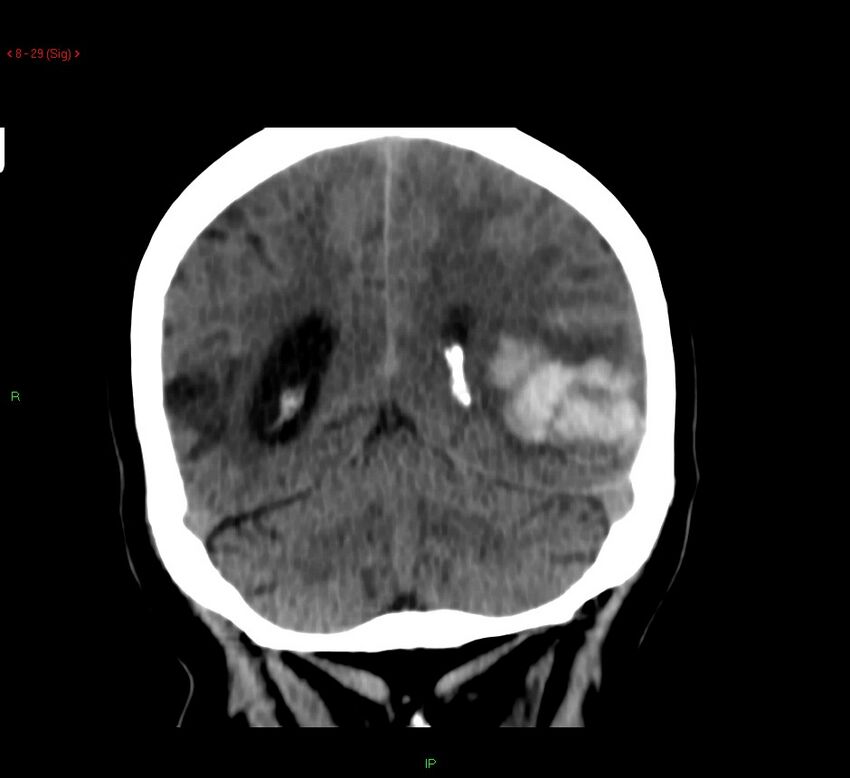 Cerebral amyloid angiopathy-associated lobar intracerebral hemorrhage (Radiopaedia 58378-65518 Coronal non-contrast 29).jpg