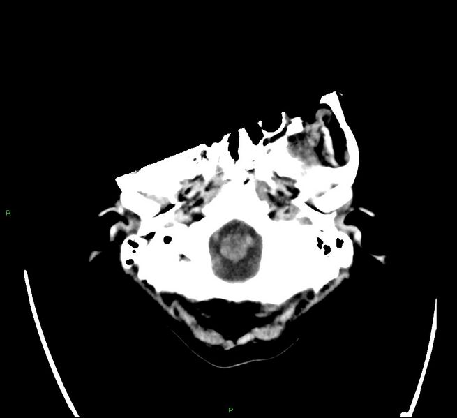 File:Cerebral amyloid angiopathy-associated lobar intracerebral hemorrhage (Radiopaedia 58566-65731 Axial non-contrast 2).jpg
