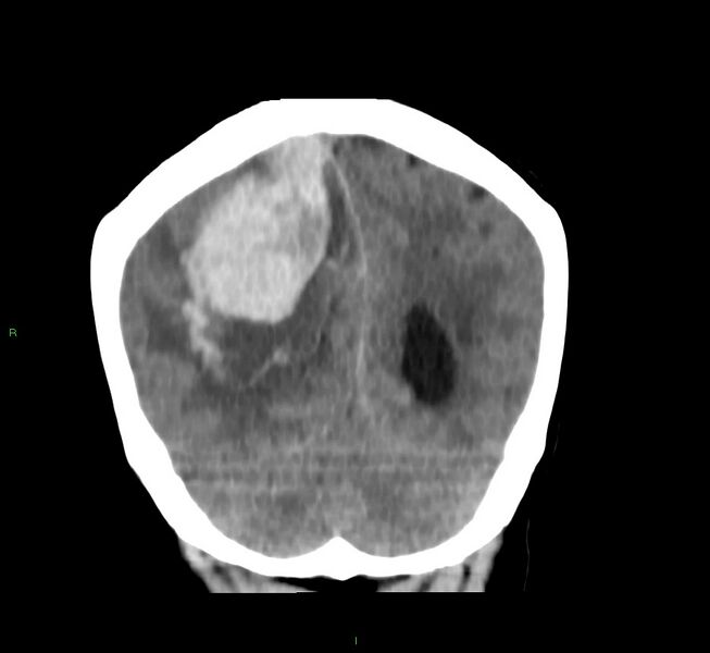 File:Cerebral amyloid angiopathy-associated lobar intracerebral hemorrhage (Radiopaedia 58751-65972 Coronal non-contrast 18).jpg