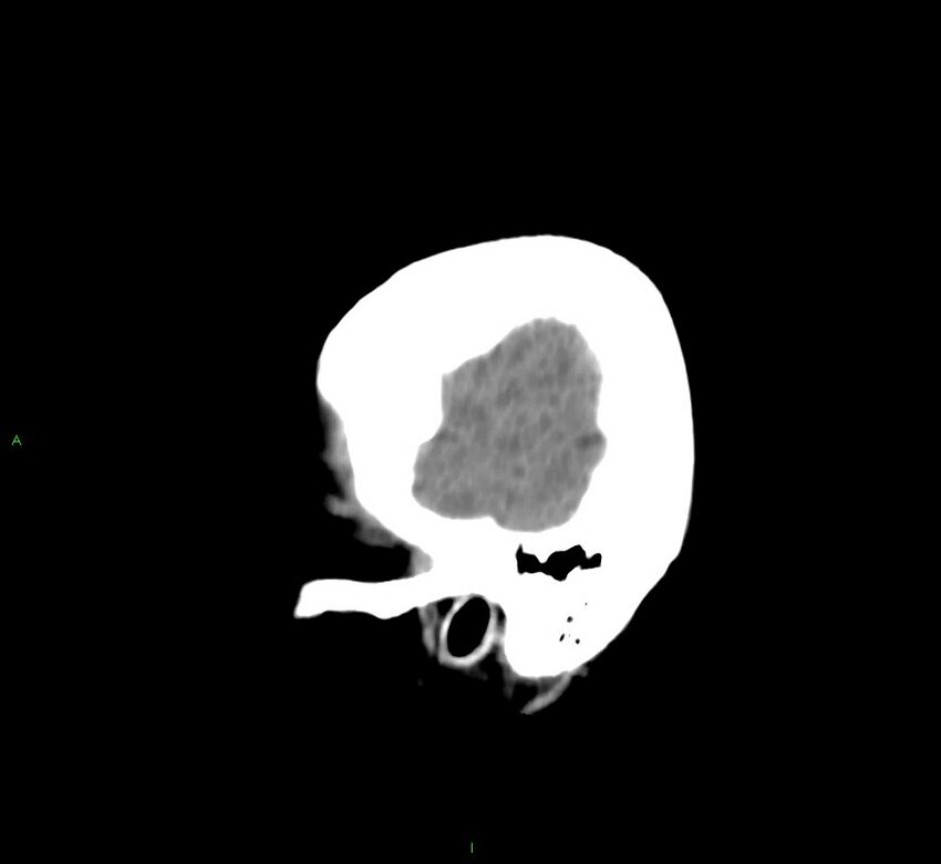 Cerebral amyloid angiopathy-associated lobar intracerebral hemorrhage (Radiopaedia 58752-65973 C 8).jpg