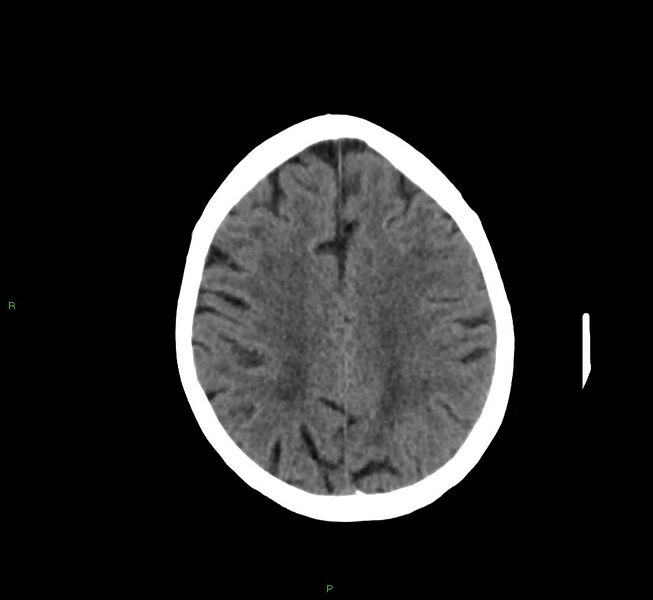 File:Cerebral amyloid angiopathy-associated lobar intracerebral hemorrhage (Radiopaedia 58757-65978 Axial non-contrast 18).jpg