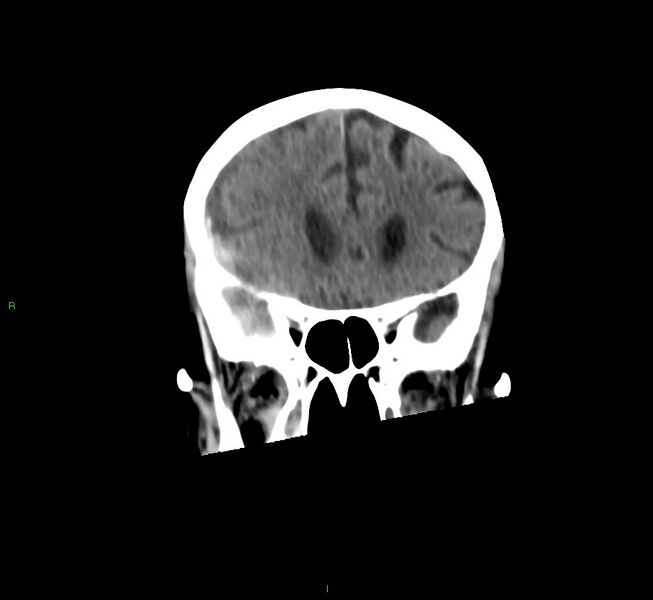 File:Cerebral amyloid angiopathy-associated lobar intracerebral hemorrhage (Radiopaedia 58758-65980 Coronal non-contrast 45).jpg