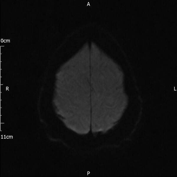 File:Cerebral amyloid angiopathy related inflammation (Radiopaedia 72772-83415 Axial DWI 43).jpg