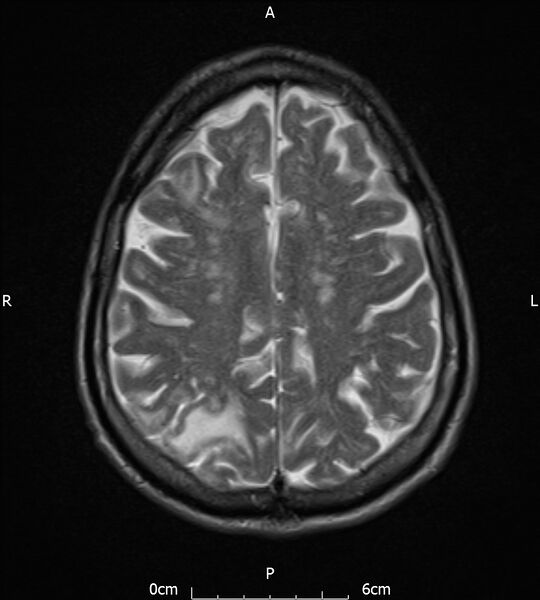 File:Cerebral amyloid angiopathy related inflammation (Radiopaedia 72772-83415 Axial T2 17).jpg