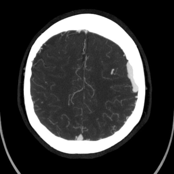 File:Cerebral arteriovenous malformation (Radiopaedia 43729-47189 B 37).jpg