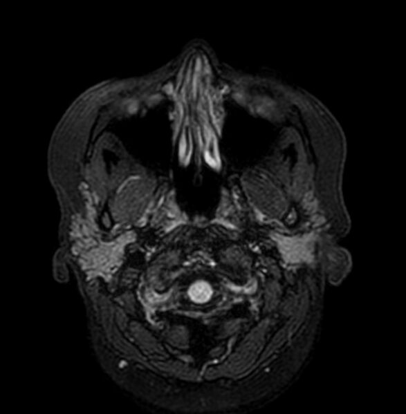 File:Cerebral arteriovenous malformation (Radiopaedia 74411-90758 Axial FLAIR 1).jpg