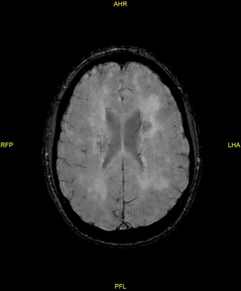 File:Cerebral autosomal dominant arteriopathy with subcortical infarcts and leukoencephalopathy (CADASIL) (Radiopaedia 86108-102054 Axial SWI 69).jpg