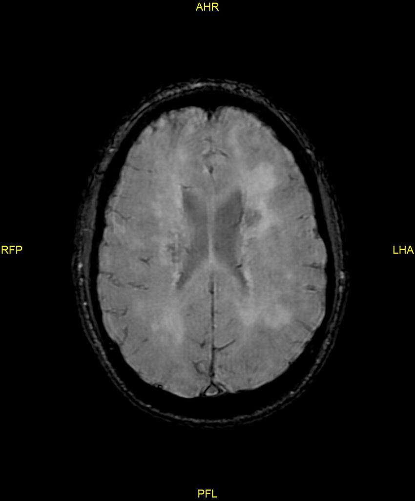 Cerebral autosomal dominant arteriopathy with subcortical infarcts and leukoencephalopathy (CADASIL) (Radiopaedia 86108-102054 Axial SWI 69).jpg